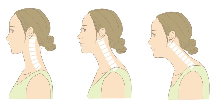スマホ首とは首の骨が前に伸びている状態